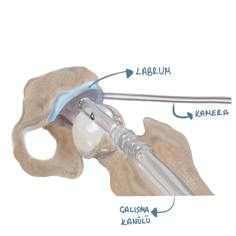 Kalça Labrum Yırtığı Ameliyatı