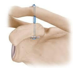 Acromioclavicular (AC) Joint Seperation Surgery