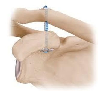 Acromioclavicular (AC) Joint Seperation Surgery