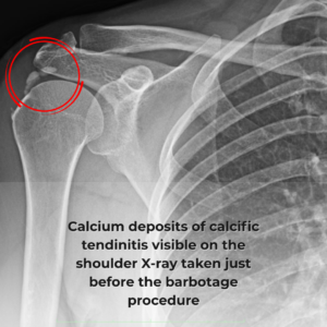 Tratamente Barbotaj Tendinită Calcifiantă înainte