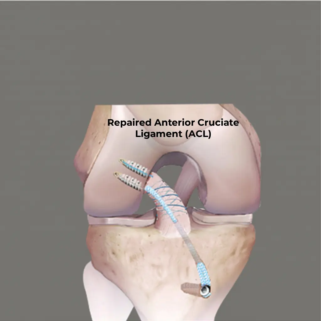 Anterior Cruciate Ligament (ACL) Repair Surgery