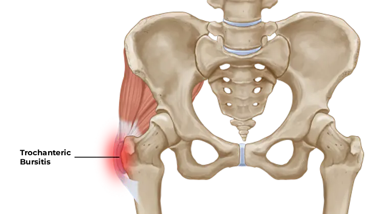 Trochanteric Bursitis – Hip Bursitis Treatment
