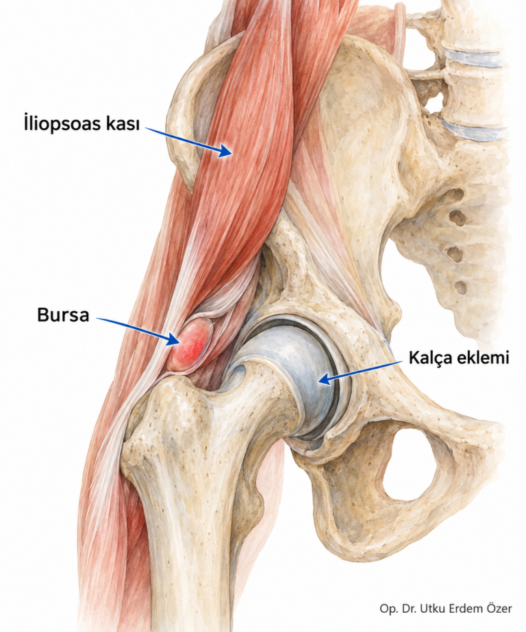 Kalçada İliopsoas Tendiniti ve Bursiti konusunu açıklayan anatomik çizim