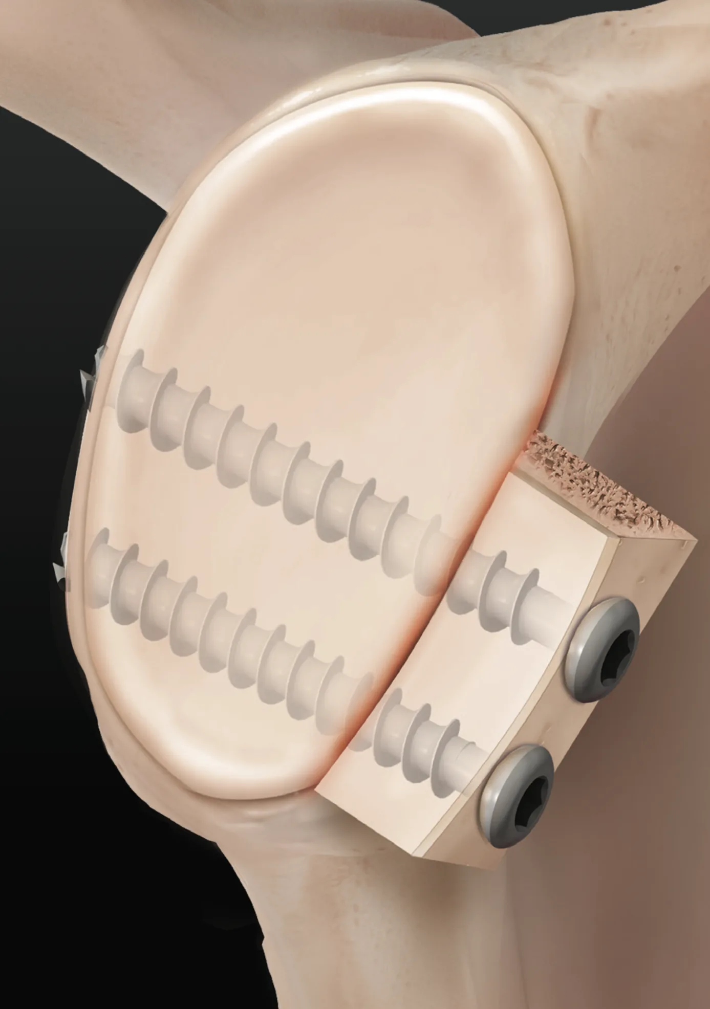 Glenoid Kemik Kaybı için Artroskopik Glenoid Destekleme (Augmentasyon)