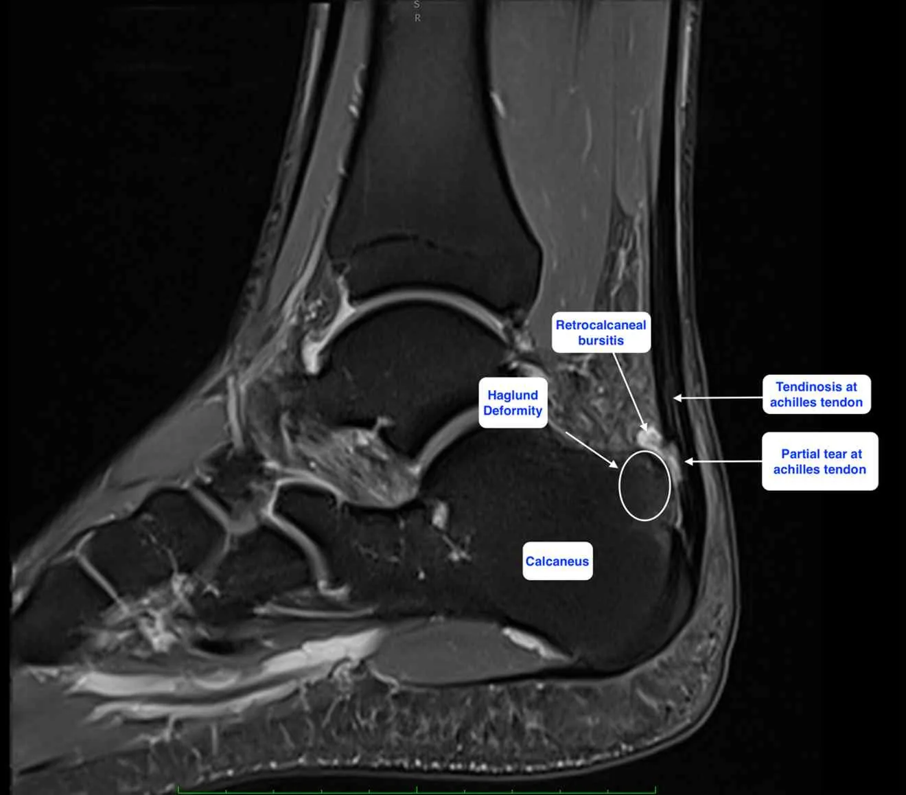 MR image of Haglund deformity, partial achilles tendon tear and retrocalcaneal bursitis
