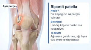 Diz kapağının üst-dış köşesinde ayrı kalan kemik parçası (bipartit patella)