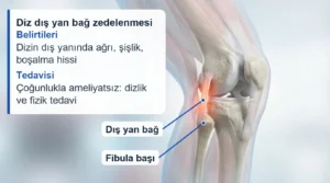 Diz dış yan bağının femur ile fibula başı arasındaki konumu